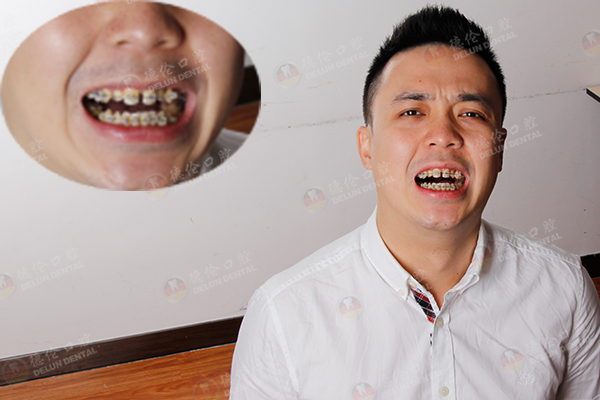 20年求医无门,他是史上最复杂的畸牙案例_广州