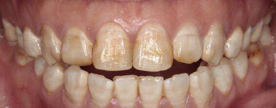 不再有难言之隐，治好氟斑牙可以一步到位_广州德伦口腔