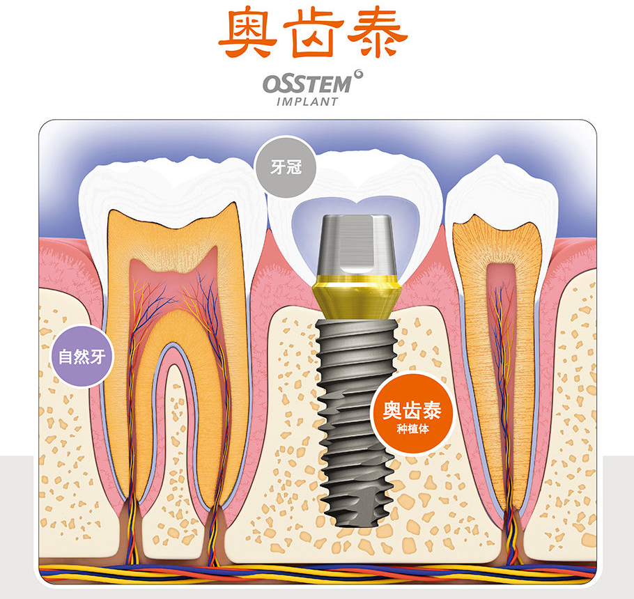 韩国奥齿泰种植系统    1,不损伤邻牙:在缺牙处的牙槽骨内植入种植体