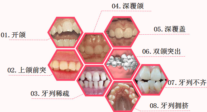 广州牙齿矫正哪家医院比较好