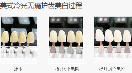 广州牙齿美白多少钱