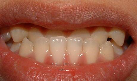 地包天牙齿矫正黄金期是何时