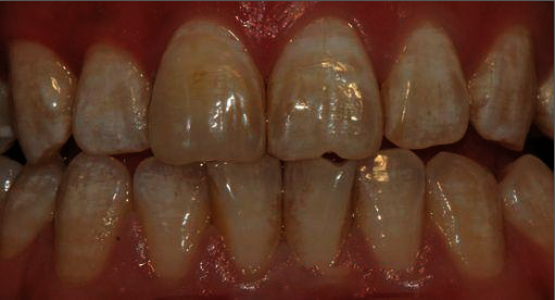 不同程度的氟斑牙要如何美白_广州德伦口腔