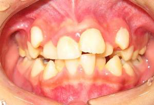 牙列拥挤有什么危害_广州德伦口腔