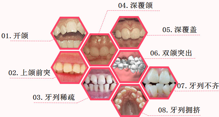 广州医院矫正牙齿