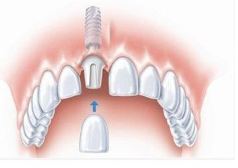 广州人工种植牙的价格一般是多少钱一颗--广州