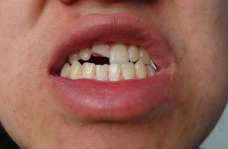 前牙缺了一块可以补吗?_广州德伦口腔