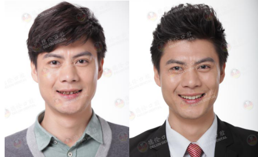 牙齿美白体验官火热招募中!德伦美牙御用专家余若鸣亲诊_广州德伦口腔