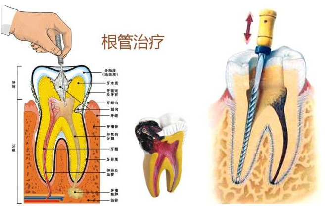 根管治疗后牙疼正常吗