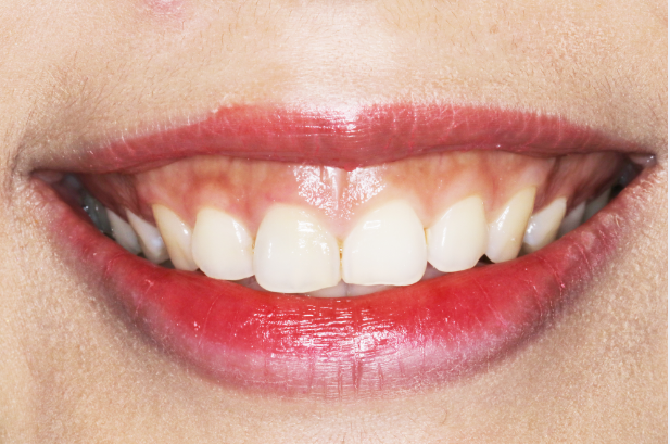 女主播因笑露牙龈被粉丝攻击