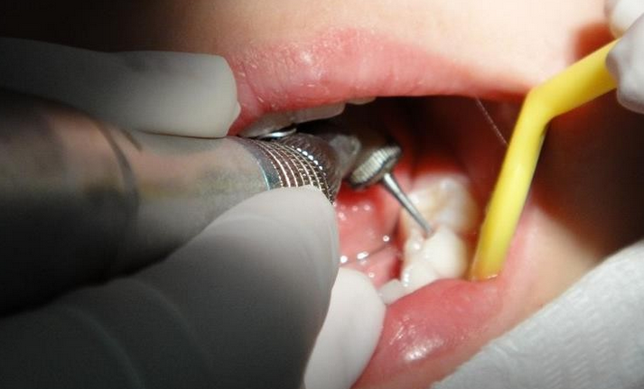 补牙用什么材料好