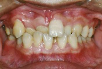 畸形牙不矫正的危害