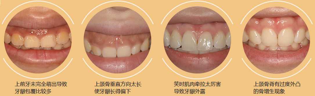根据牙龈美学的定义,正常的微笑,牙龈暴露在2mm以内,而露龈