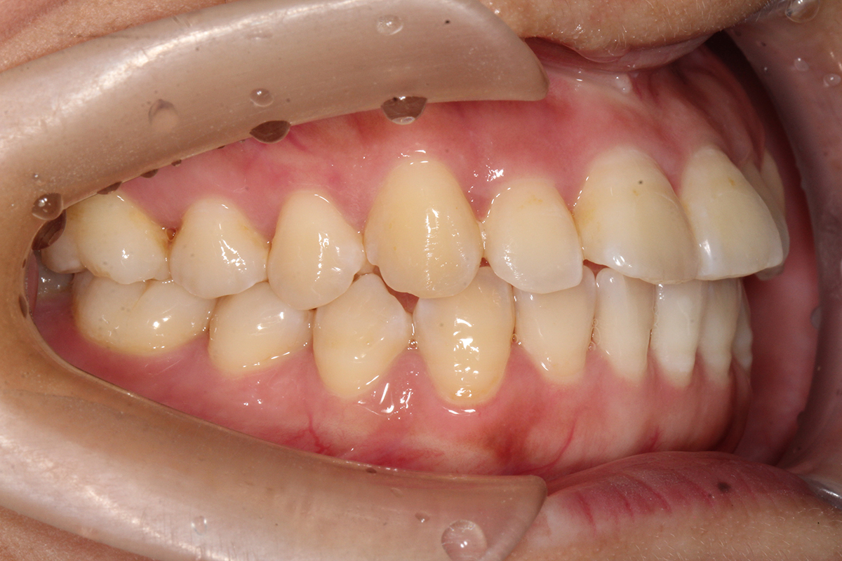 骨性龅牙和牙性龅牙有什么区别？ - 知乎