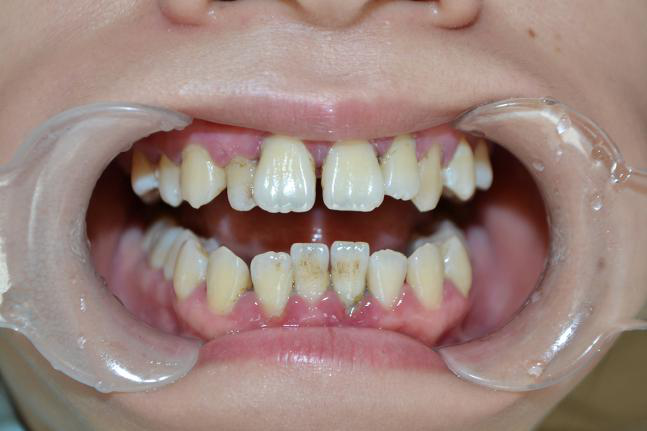 牙齿错位怎么办