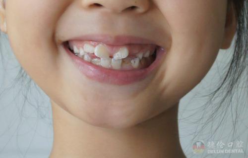 小孩子什么时候矫正牙齿好