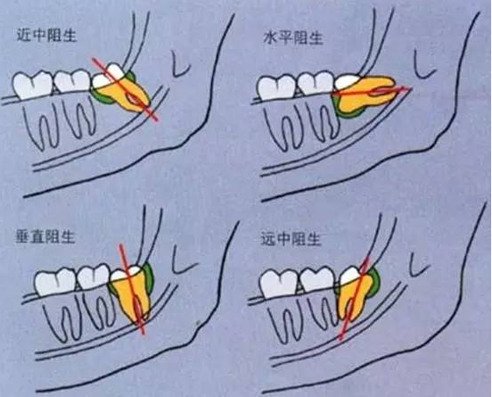 啥是智牙 129-1P4101JHa01.png
