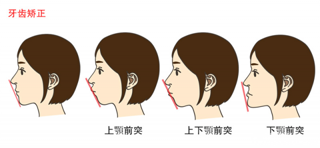 牙齿畸形类型