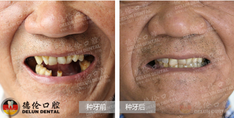 种植牙医院排名