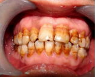 怎样去除氟斑牙