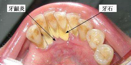 口腔结石怎么来的 129-1P52Q62G1527.png