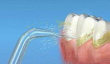 洗牙一般要多长时间