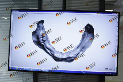 种植牙为什么这么贵