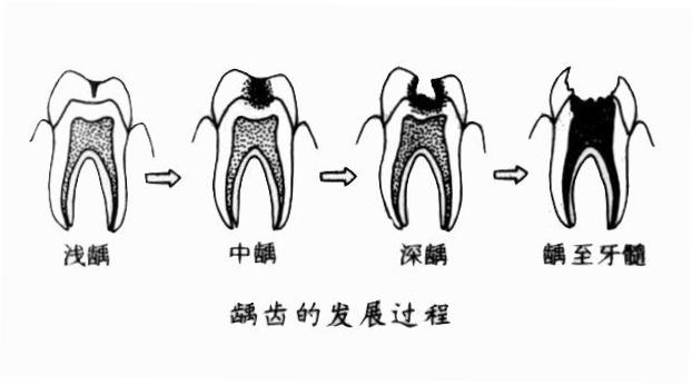 扬州儿童龋齿怎么治疗