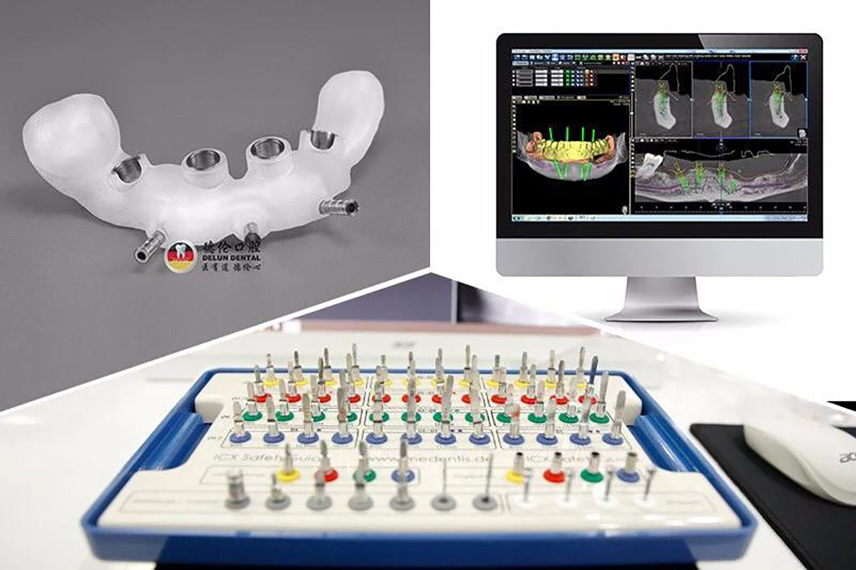 北京中医医院顺义医院口腔科完成首例数字化导板引导下全口无牙颌种植-医院汇-丁香园