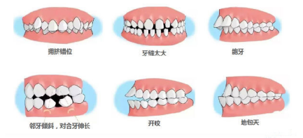小孩牙齿矫正需要注意什么 129-1PQ11J949126.png