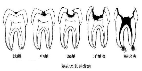 龋齿发坏
