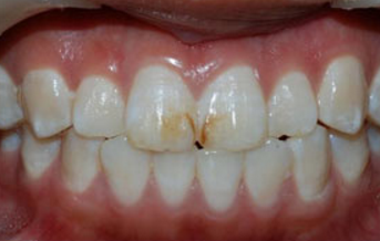 怎样可以去除氟斑牙?_广州德伦口腔