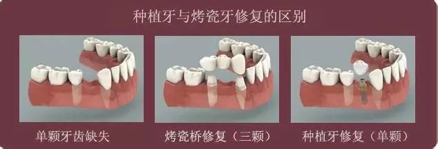 种植牙与烤瓷牙修复的区别
