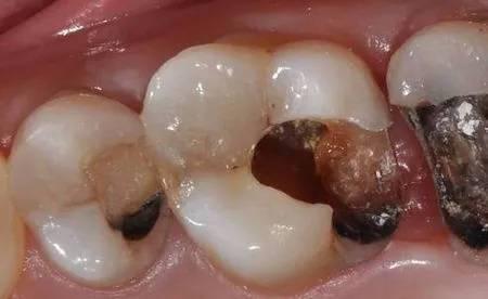 龋齿的治疗方法及价格