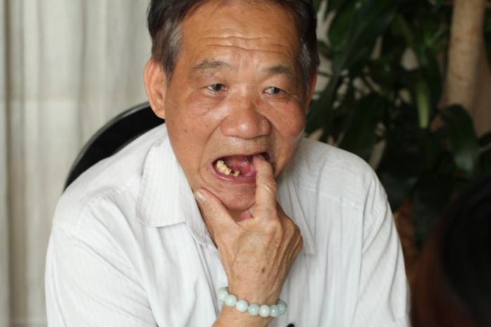 怎么预防老年人掉牙