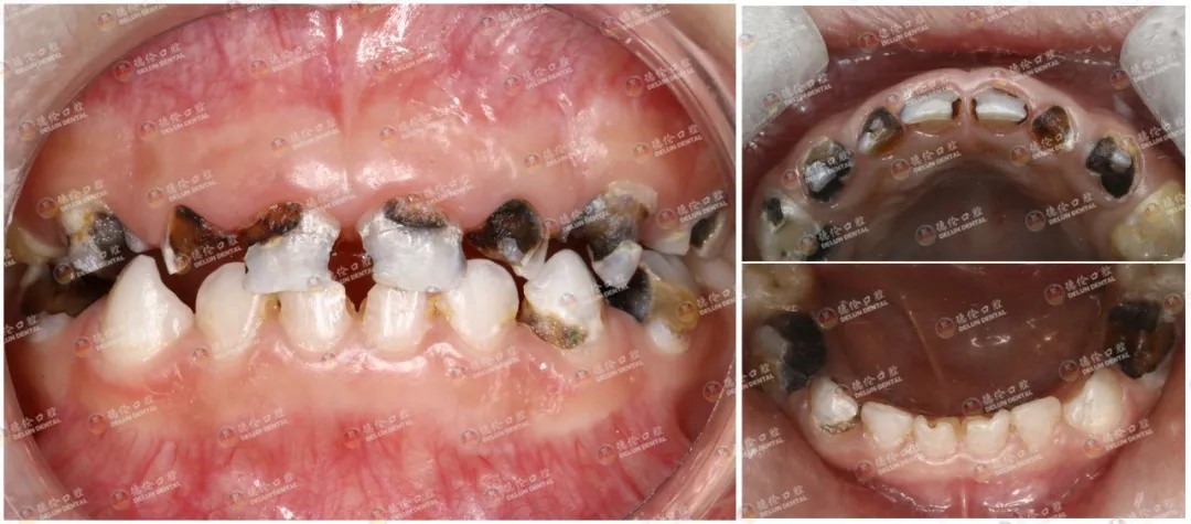 患者上颌门牙和乳磨牙等多颗牙齿发生严重龋坏