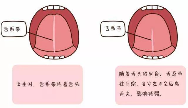 家长注意小孩发音不清晰警惕系舌系带过短